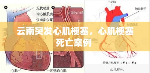 云南突發(fā)心肌梗塞，心肌梗塞死亡案例 