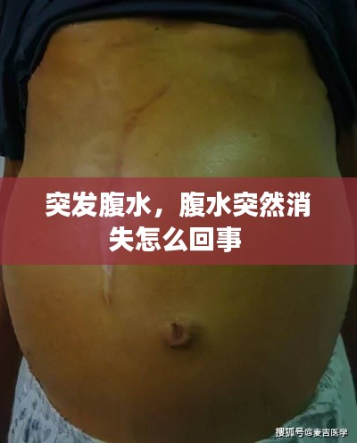突發(fā)腹水，腹水突然消失怎么回事 