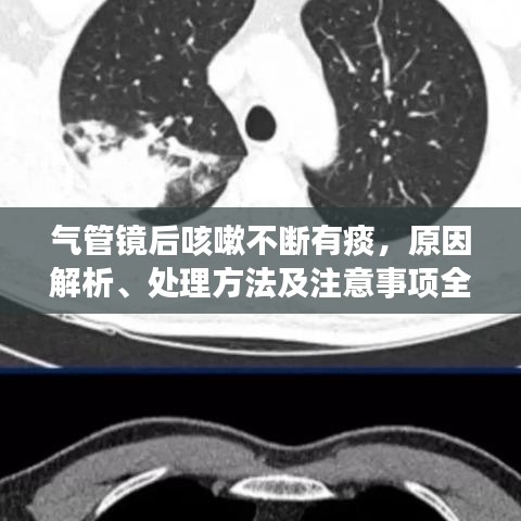 氣管鏡后咳嗽不斷有痰，原因解析、處理方法及注意事項全攻略