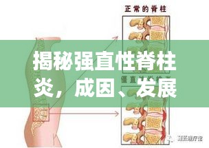 揭秘強直性脊柱炎，成因、發(fā)展與突發(fā)性的真相解析